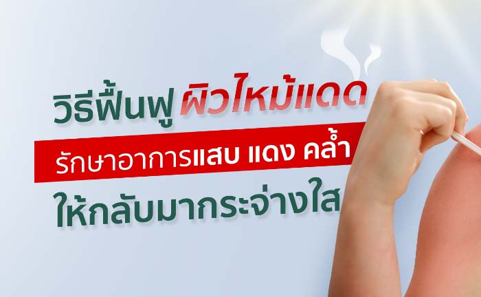 ผิวไหม้แดด
